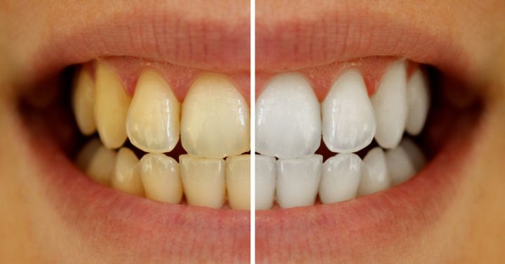 successful-treatment-for-whitening-yellow-teeth