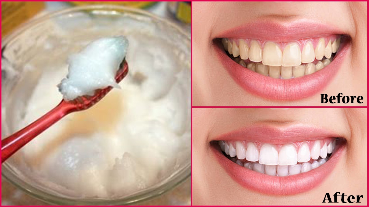 successful-treatment-for-whitening-yellow-teeth