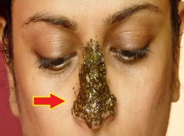 Blackheads disappear in just minutes - adopt these methods