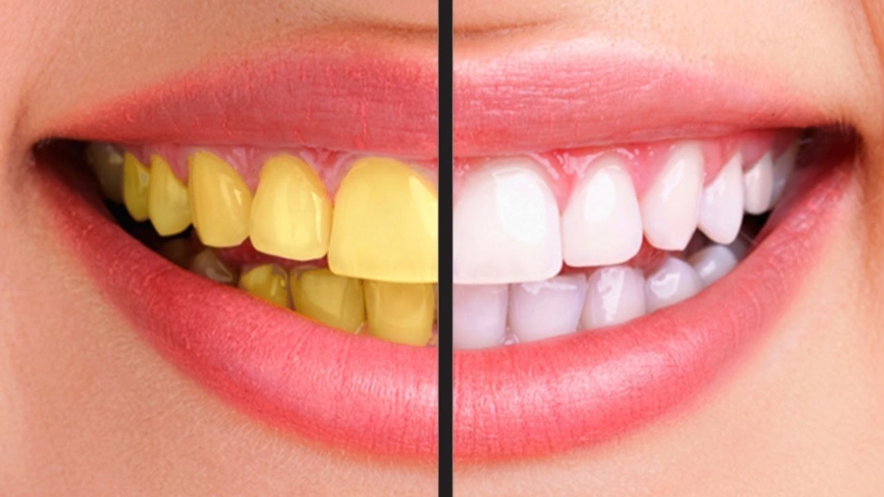 yellow teeth