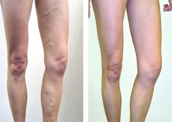 Be careful it is spreading rapidly, Varicose Veins fatal disease, know the cause and the prevention measures