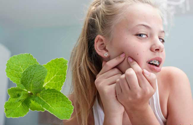 Treat with mint to eliminate nail pimples and brighten your face चेहरे