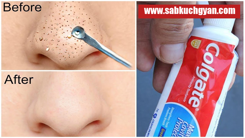 remove black head with toothpaste easy way tips for beauty