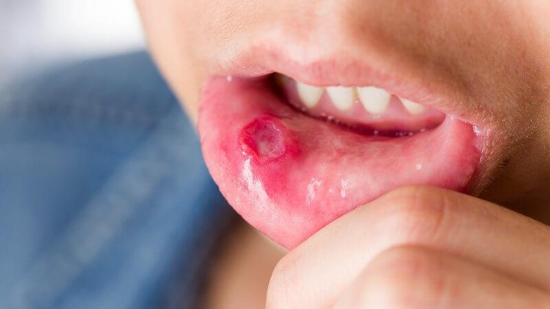 Remove mouth blisters with home remedies and get rest immediately मुंह