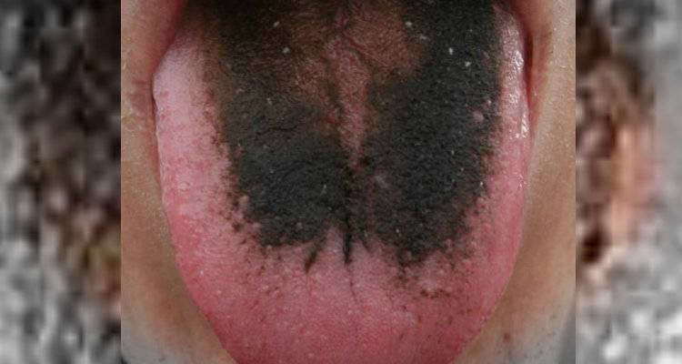 This girl has a strange disease, tongue gets hair !! (1)