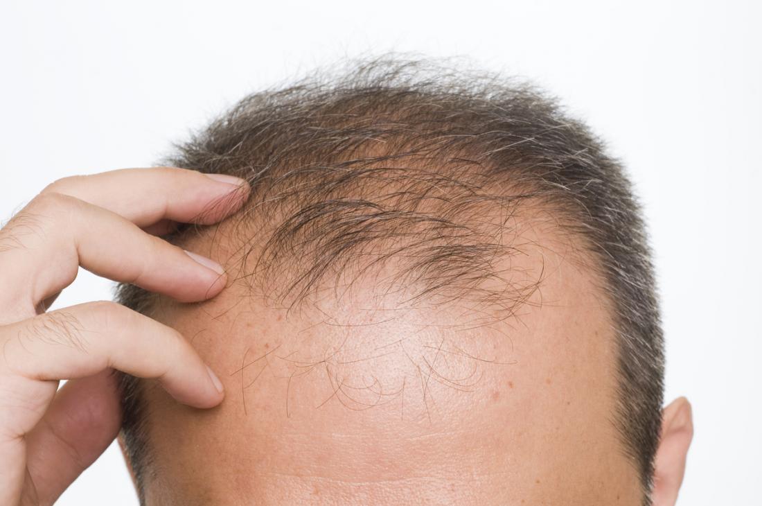 Are you troubled by baldness? So just mix this thing in coconut oil and hair will come गंजेपन
