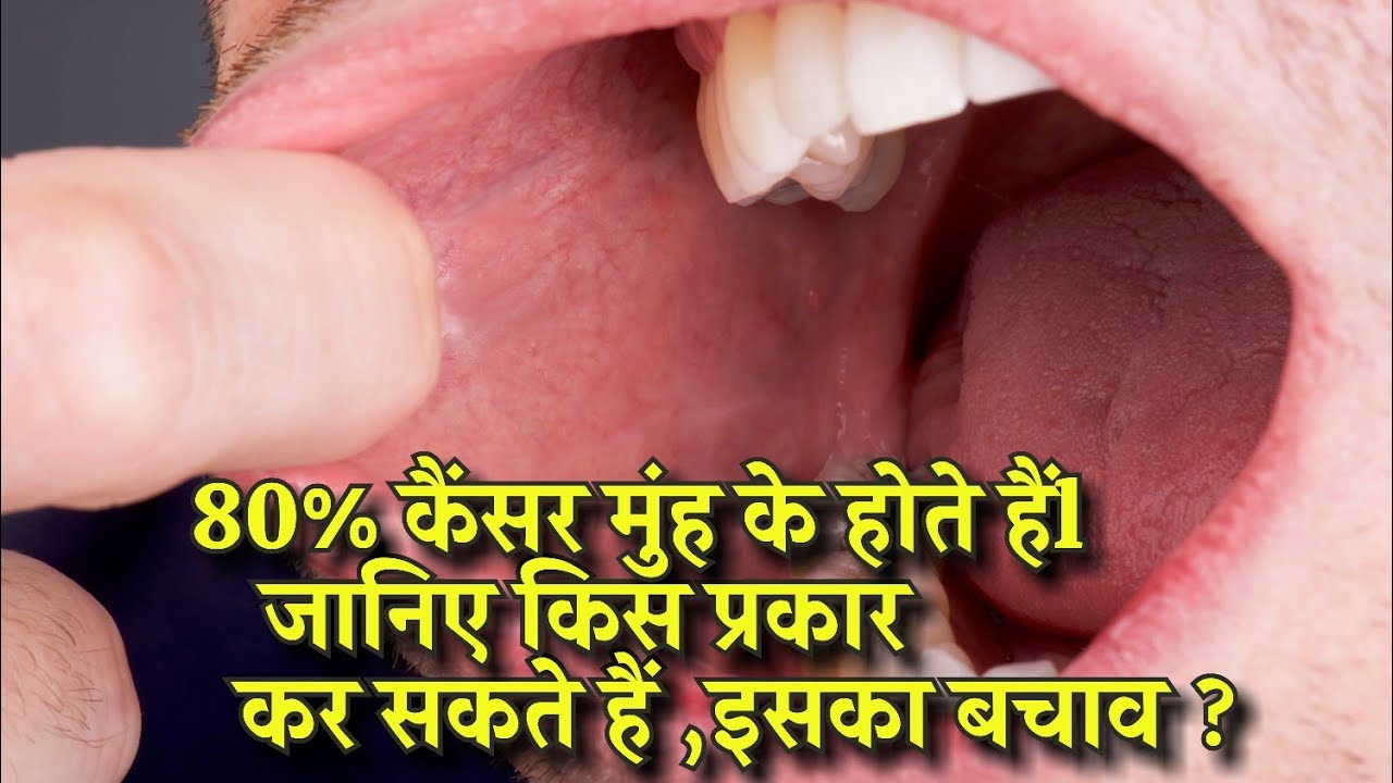 Do not ignore these signs - mouth cancer can happen