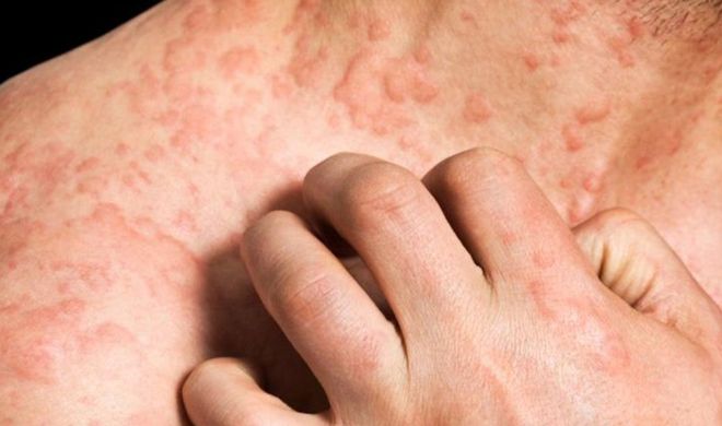 Eczema Types, Treatment, Home Remedies and Symptoms