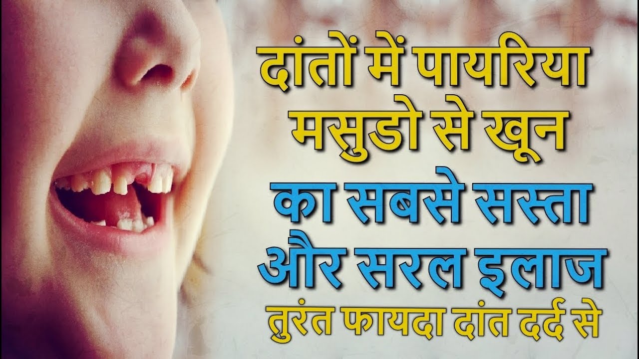 Blood and teeth in the teeth and gums, eliminate all diseases of pyorrhea pain from the root, see these home remedies