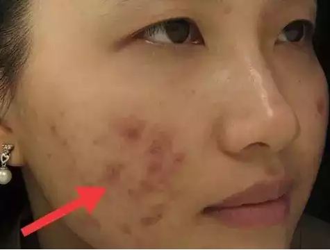 All pimples will disappear in just 1 week पिंपल्स
