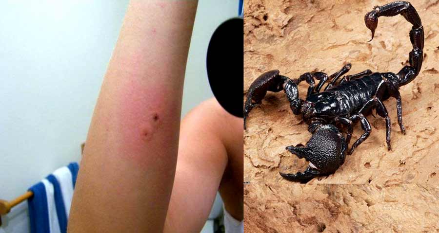 To get a scorpion poison, just do these 5 measures बिच्छू