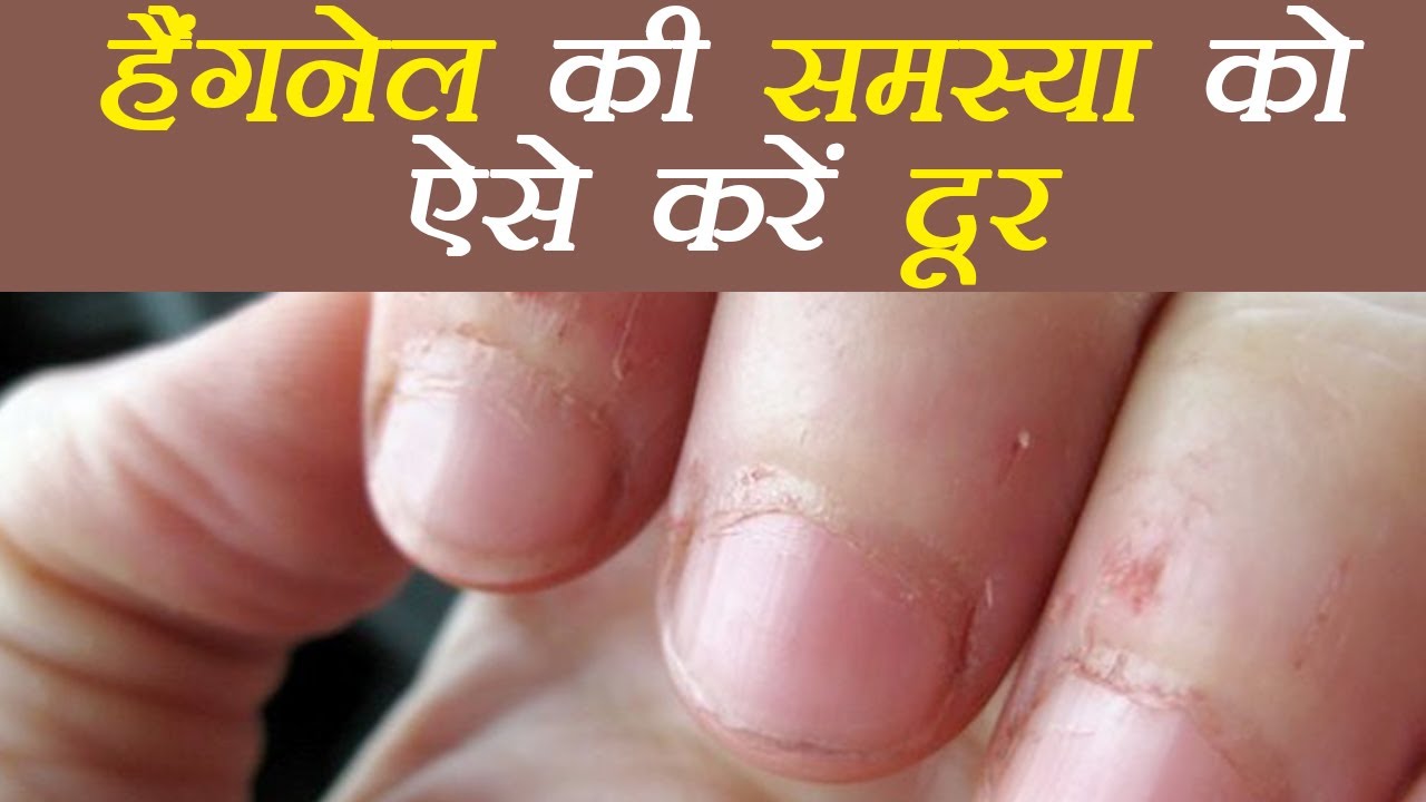 If you are also troubled by nail skin, then definitely read this news