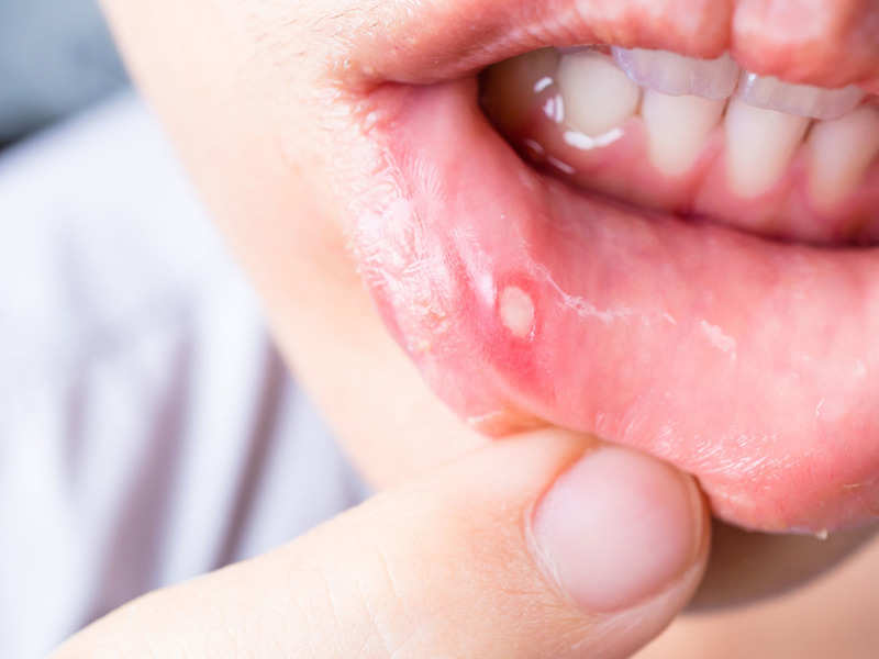 Repeated mouth blisters, these 5 effective methods to cure मुंह