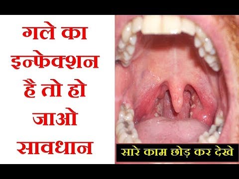 if-you-have-throat-pain-and-throat-infection-follow-these-home-remedies इंफेक्शन