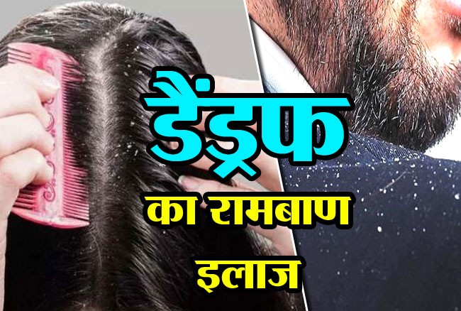 If you are also troubled by dandruff, then follow these 5 home remedies डैंड्रफ