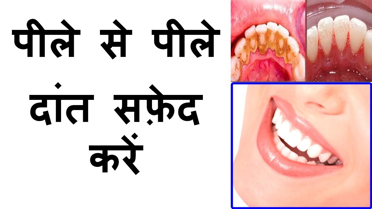 The teeth have to be whitened again, then this 3 things will come to you पीलें दांतो