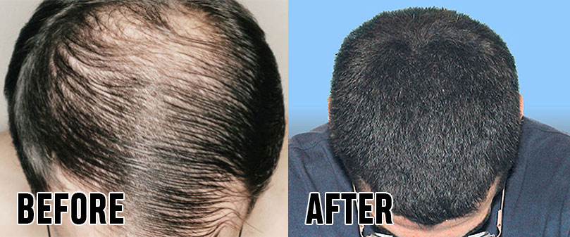 Get rid of baldness, just apply potato juice, know how आलू का रस