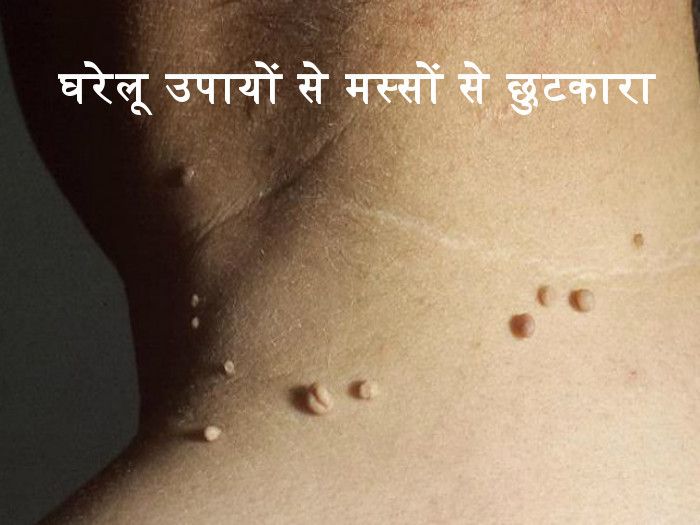 Troubled by the warts of the body, this remedy will eliminate them from the root मस्सो