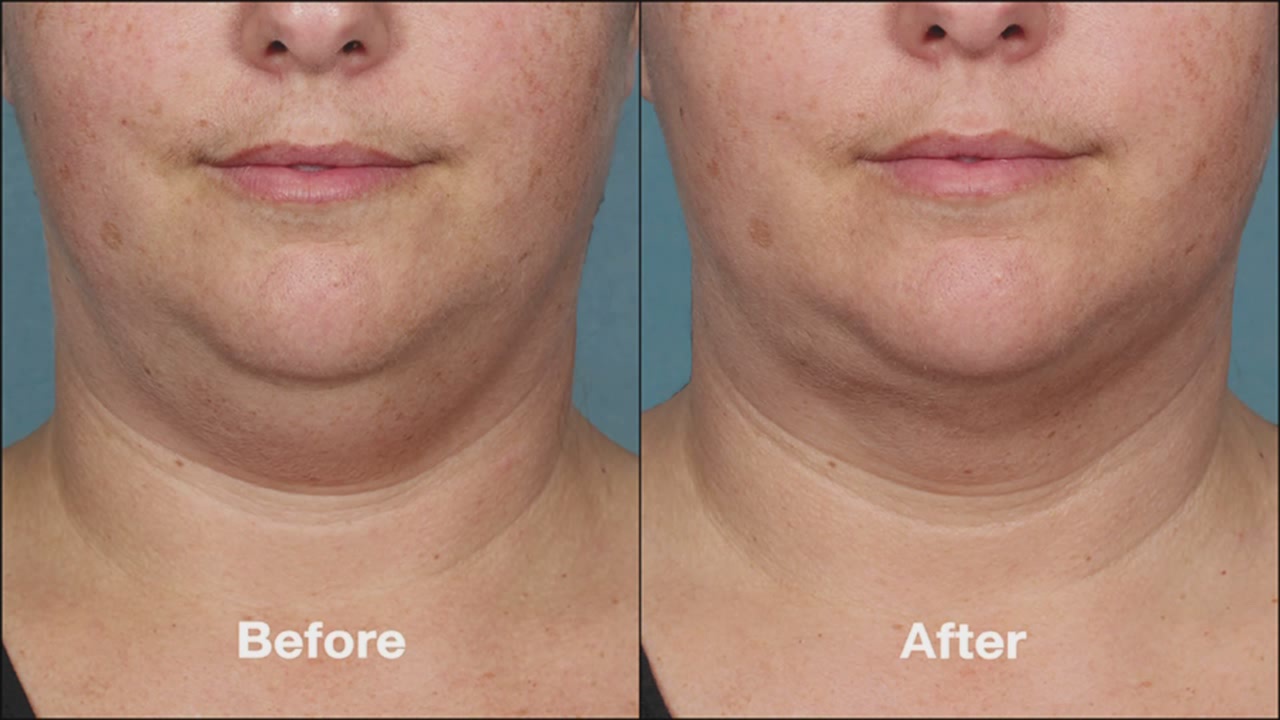 If you want to get rid of double chin, then follow this method again
