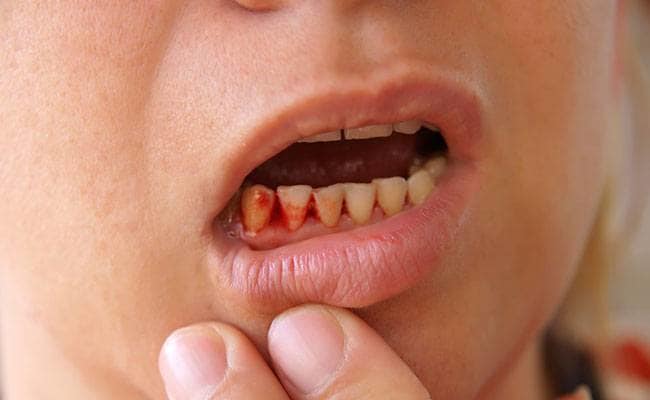 Are you also troubled by the bleeding in the gums, then this home remedy will create blood forever मसूड़ों