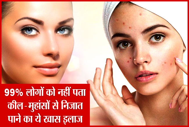 मुंहासे हटाने के लिए 9 home remedies to remove pimples on your face