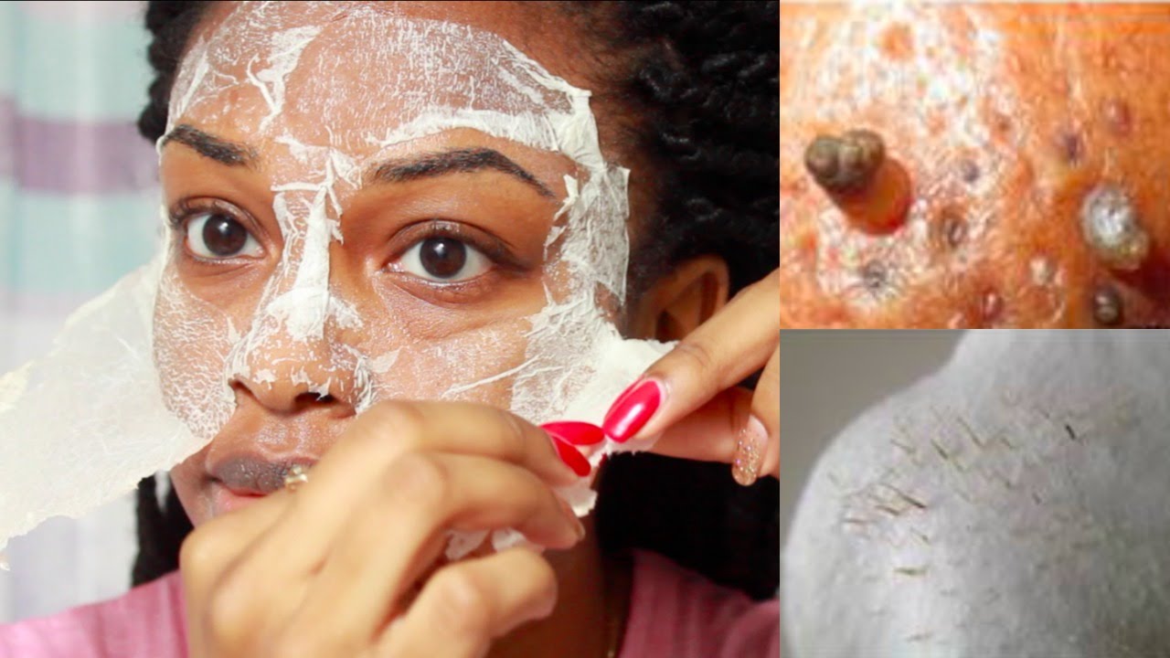 2 successful ways to treat the removal of blackheads with eggs अंडे