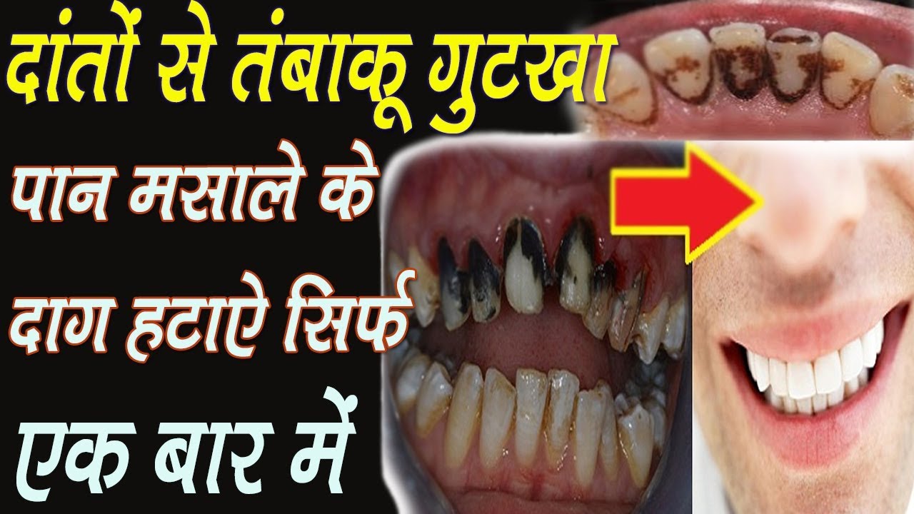 Tobacco, gutka destroy your teeth if it is bad then adopt this formula तंबाकू