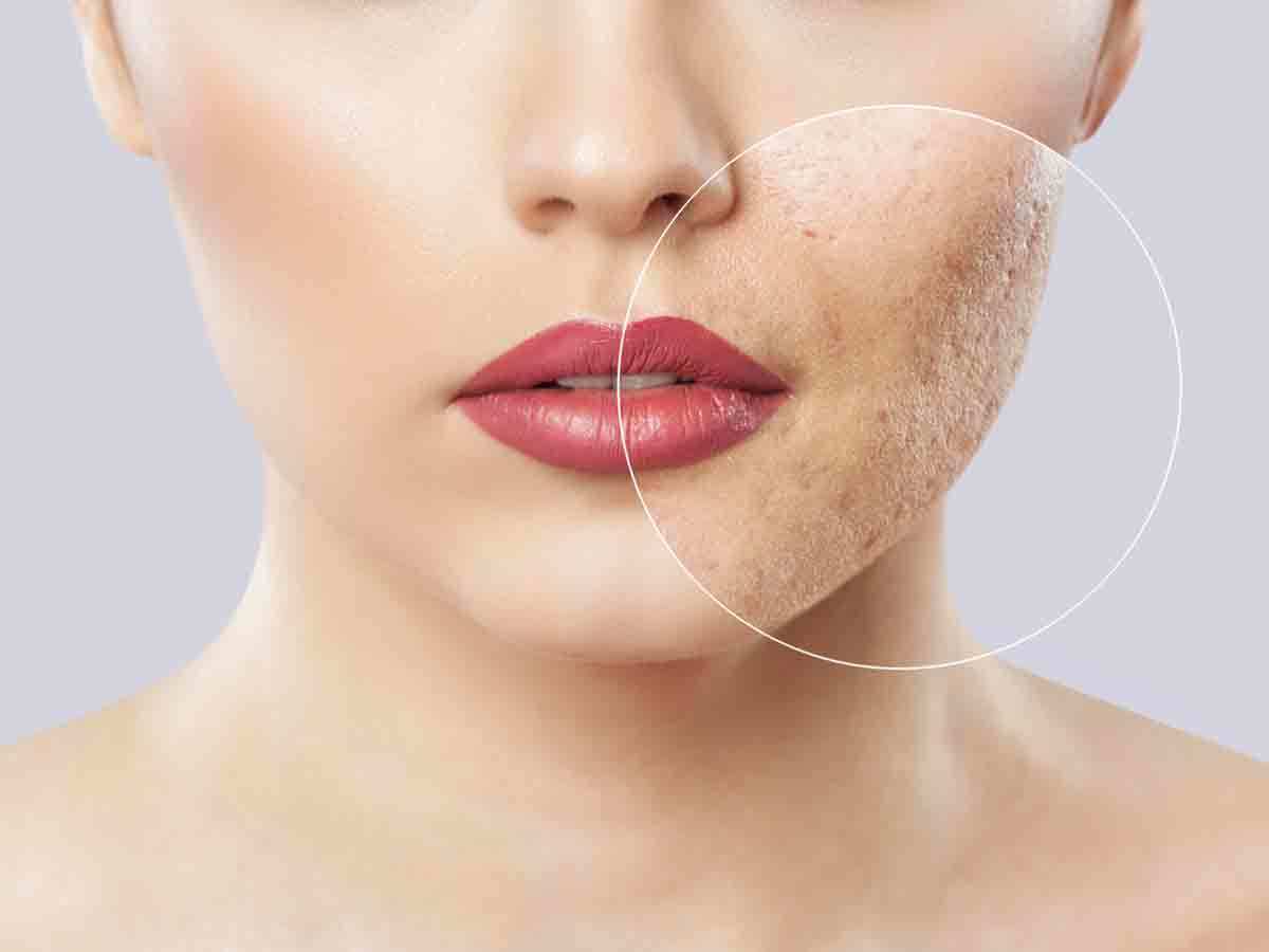 Know how to remove facial blemishes in 5 days चेहरे
