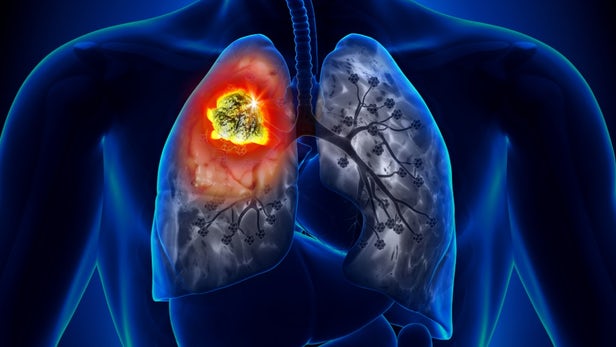 Do you know these 3 causes of dangerous lung cancer लंग्स