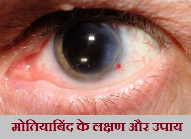 Follow this miraculous treatment for motiabind cataract