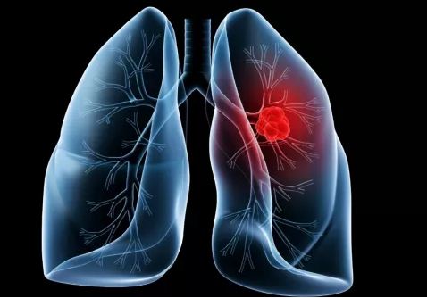 These things are very important to know about lung cancer फेफड़ों