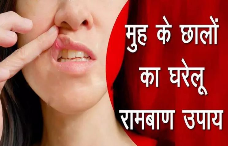 Domestic and effective remedies for mouth ulcers, definitely try once