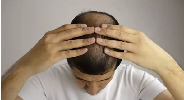 Using onion like this will also make your hair so dense