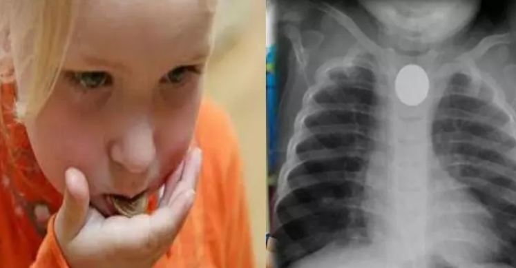 If the coin gets stuck in the child's neck, remove it this way.