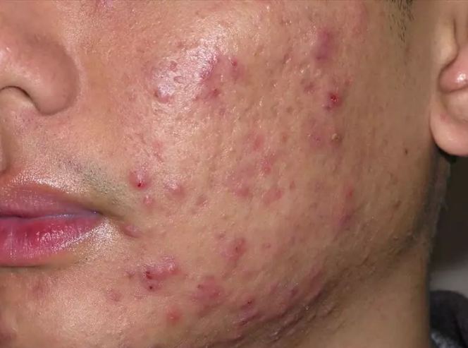Troubled by pimples, do this remedy immediately
