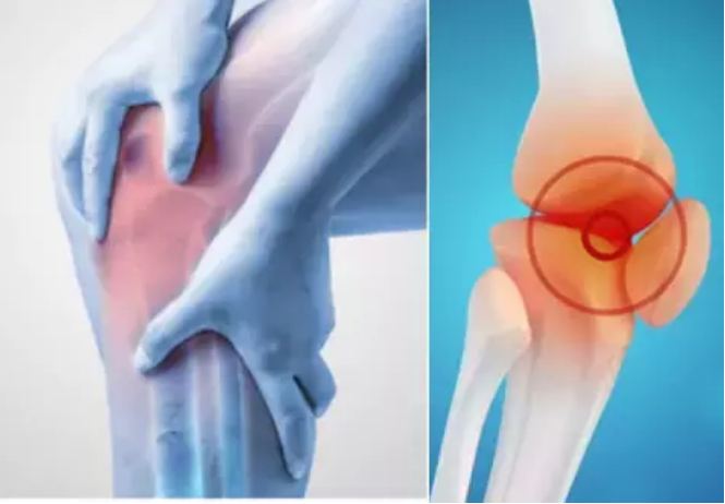 Do not panic if you have arthritis in the knee, this is not a sign of old age, do these easy home remedies
