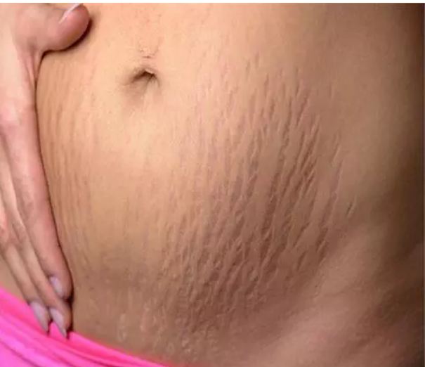 An easy way to get rid of stretch marks that have come during pregnancy
