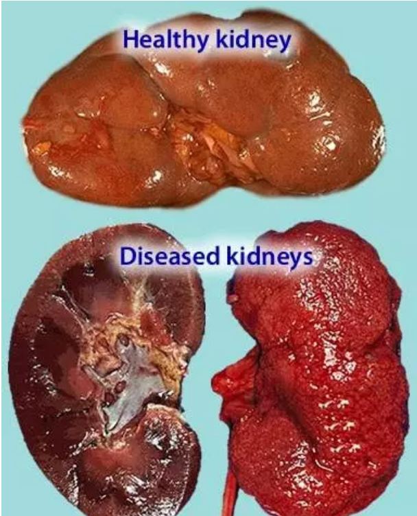 Be careful not to forget, if there are 5 mistakes, then your kidney may fail
