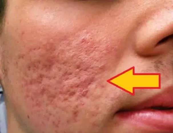 If you are troubled by face pits and scars, then do this easy solution today