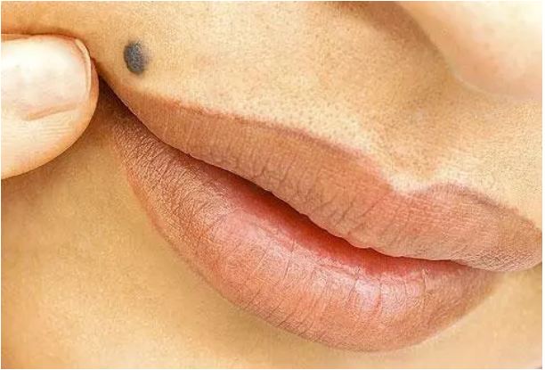 If you have a mole in these 3 places of your lips, know what it means