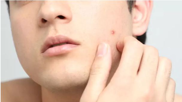 If men are fed up with pimples, then adopt this easy solution with lemon