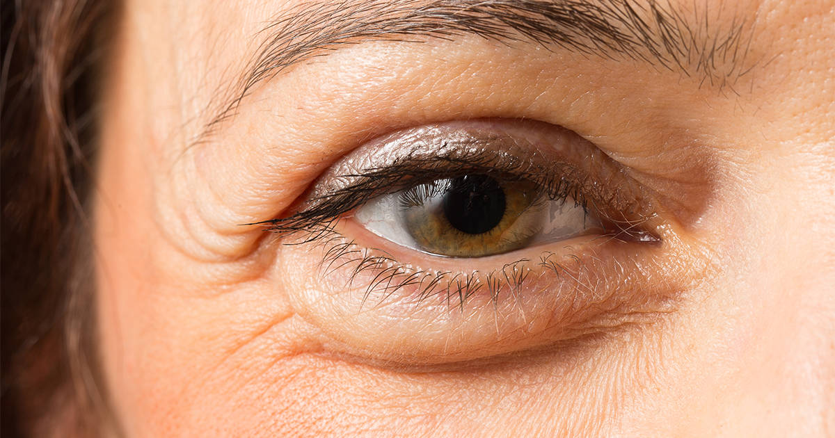 Most effective home remedies to cure inflammation of eyes