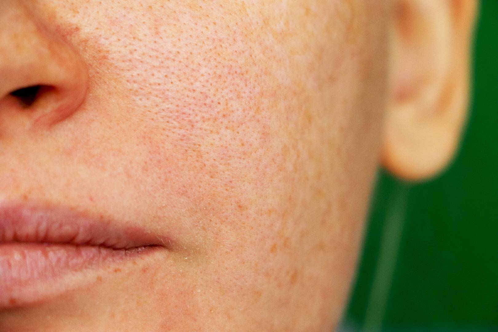 Close the open pores of the face with this home remedy in just 3 days