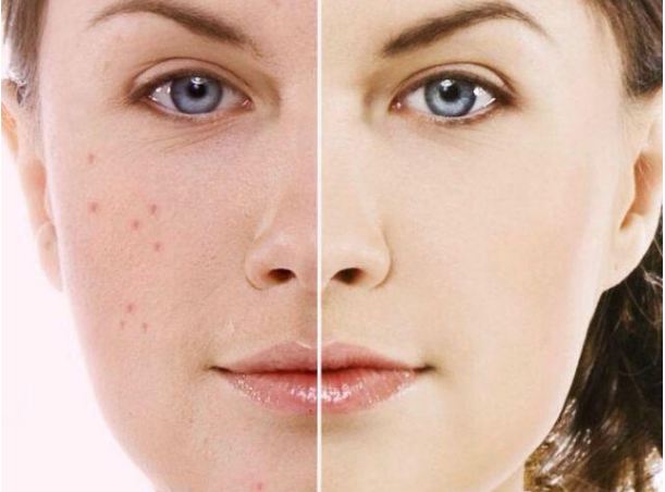 Follow these home remedies to get fresh skin by removing stains from the face