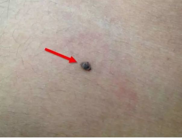 If you have a mole mark on your stomach, you must read this news once