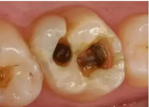 The most successful domestic recipe for killing tooth worms, must be read by clicking