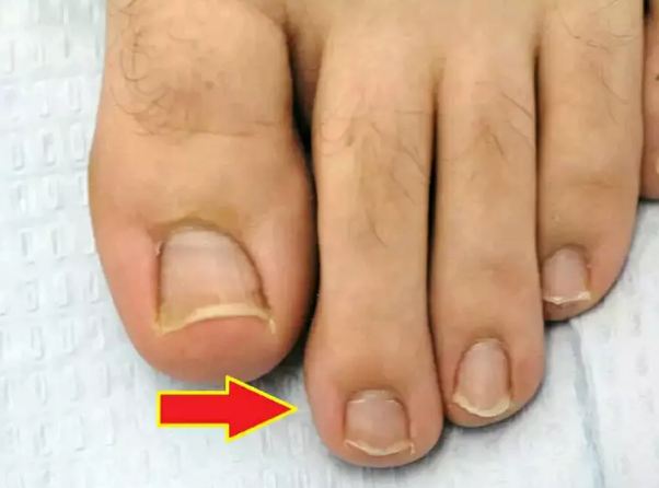If you also have a big toe of your foot, then be careful