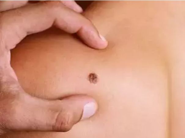 If mole is at this place of your body, then you are very lucky