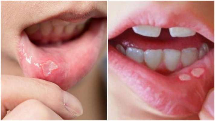 Know 3 reasons why mouth sores occur
