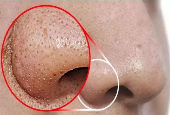 This awesome recipe will remove blackhead from face forever, definitely know